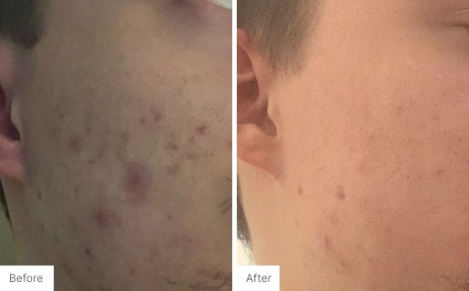 Acne Real Results Image 1
